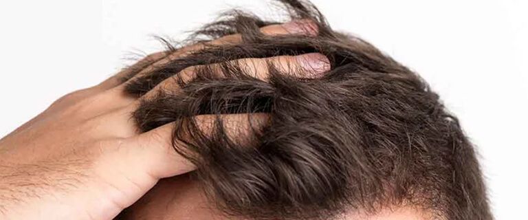 Hair Transplant Procedures