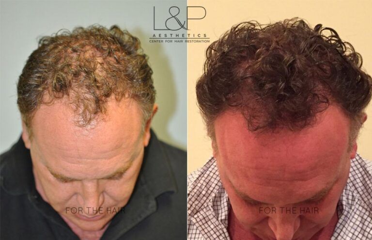 Closeup view of senior man before and after hair loss treatment