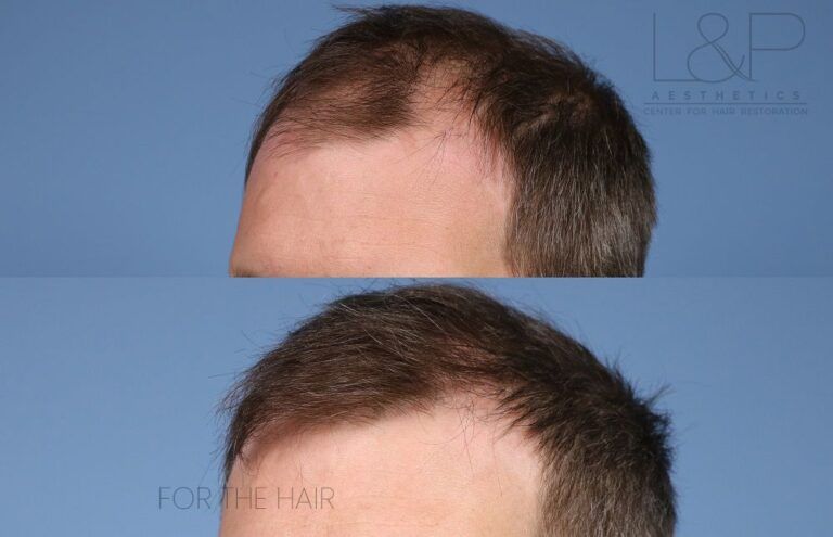 before and after bald head of a man.
