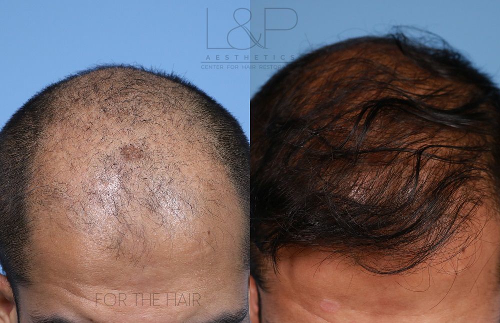 The head of a balding man before and after hair transplant surgery.
