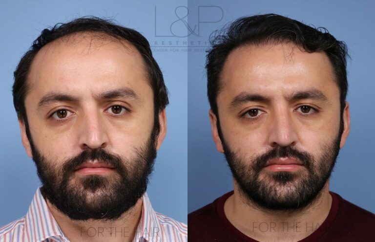 Man before and after hair loss treatment on grey background