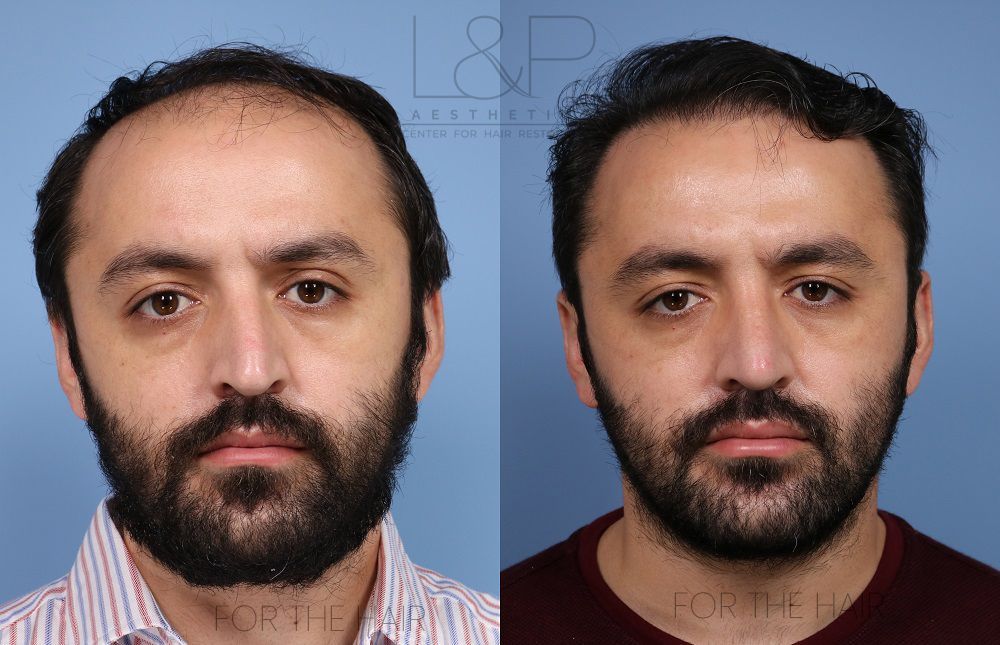 Man before and after hair loss treatment on grey background