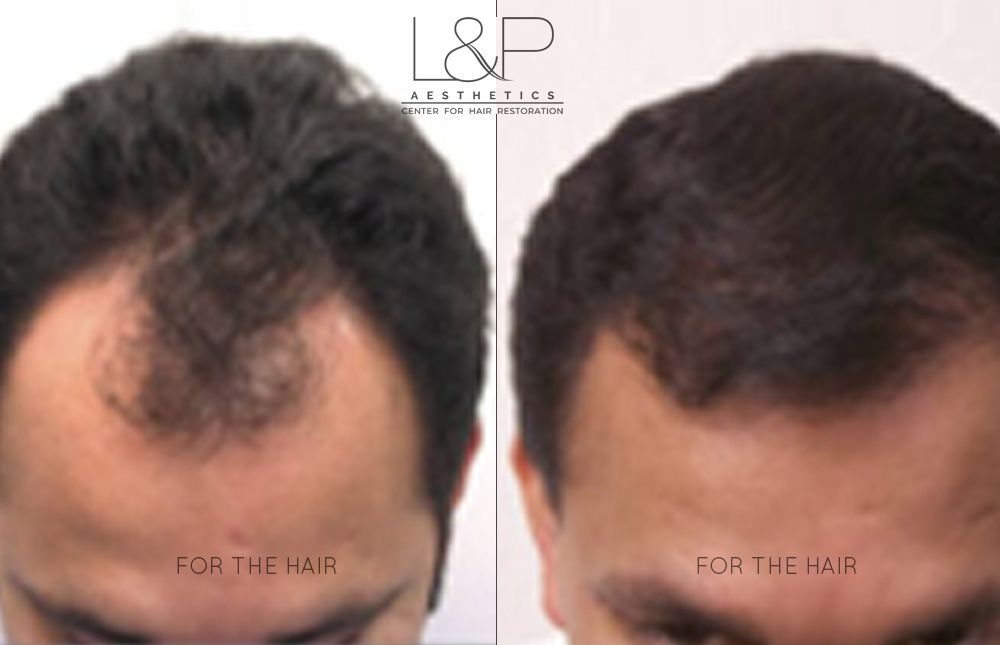 Asian man's hair loss Back Head