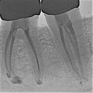 18 AND 19 BOTH TREATED WITH GENTLEWAVE® LONG CANALS WITH APICAL BRANCHING