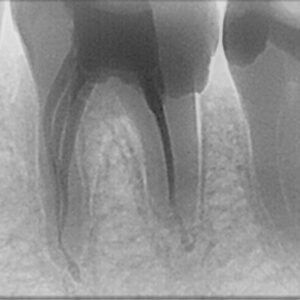 MAINTAINING NATURAL CURVATURE OF 3 CANALS IN MESIAL ROOT