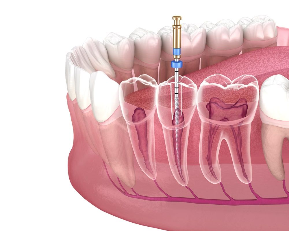 Endodontic root canal treatment process