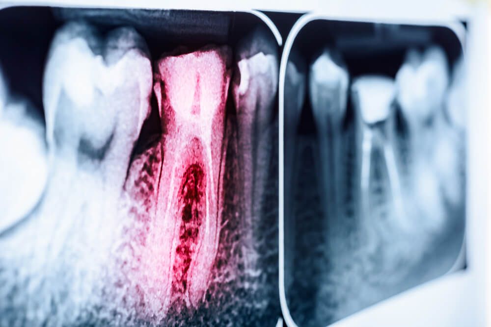 Pain Of Tooth Decay On Teeth X-Ray