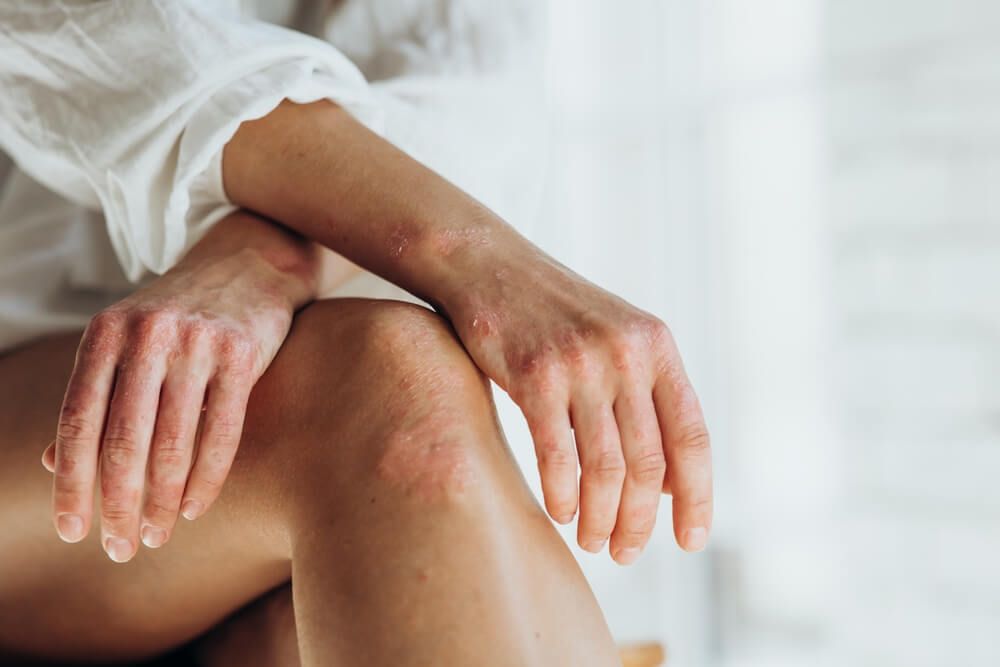 Acute psoriasis on the knees