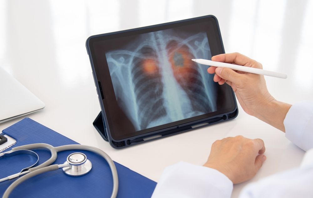 doctor reviewing xray as part of cancer screening