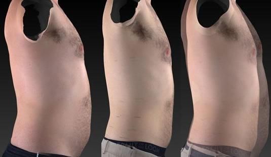 Before and After Full Body Men Treatment