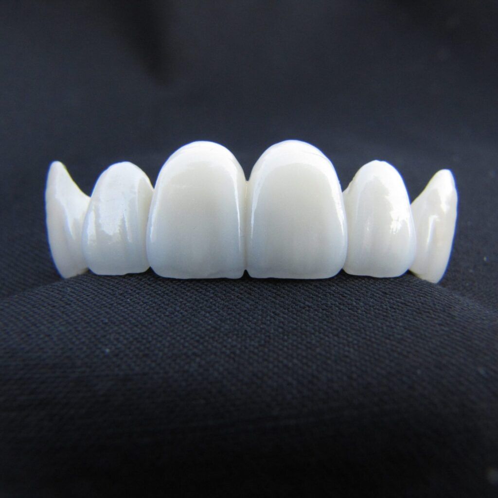 All porcelain bridge for dental treatment