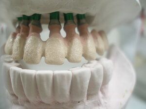 Dental Implant model