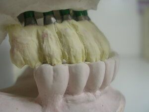 Dental Implant model