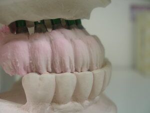 Dental Implant model