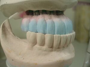 Dental Implant model