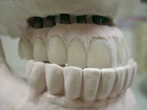 Dental Implant model