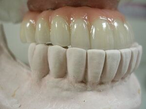 Dental Implant model