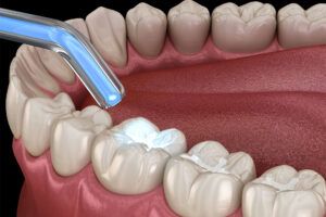 Tooth restoration with filling and polymerization lamp