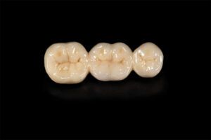 Ceramic tooth crowns and metal pins