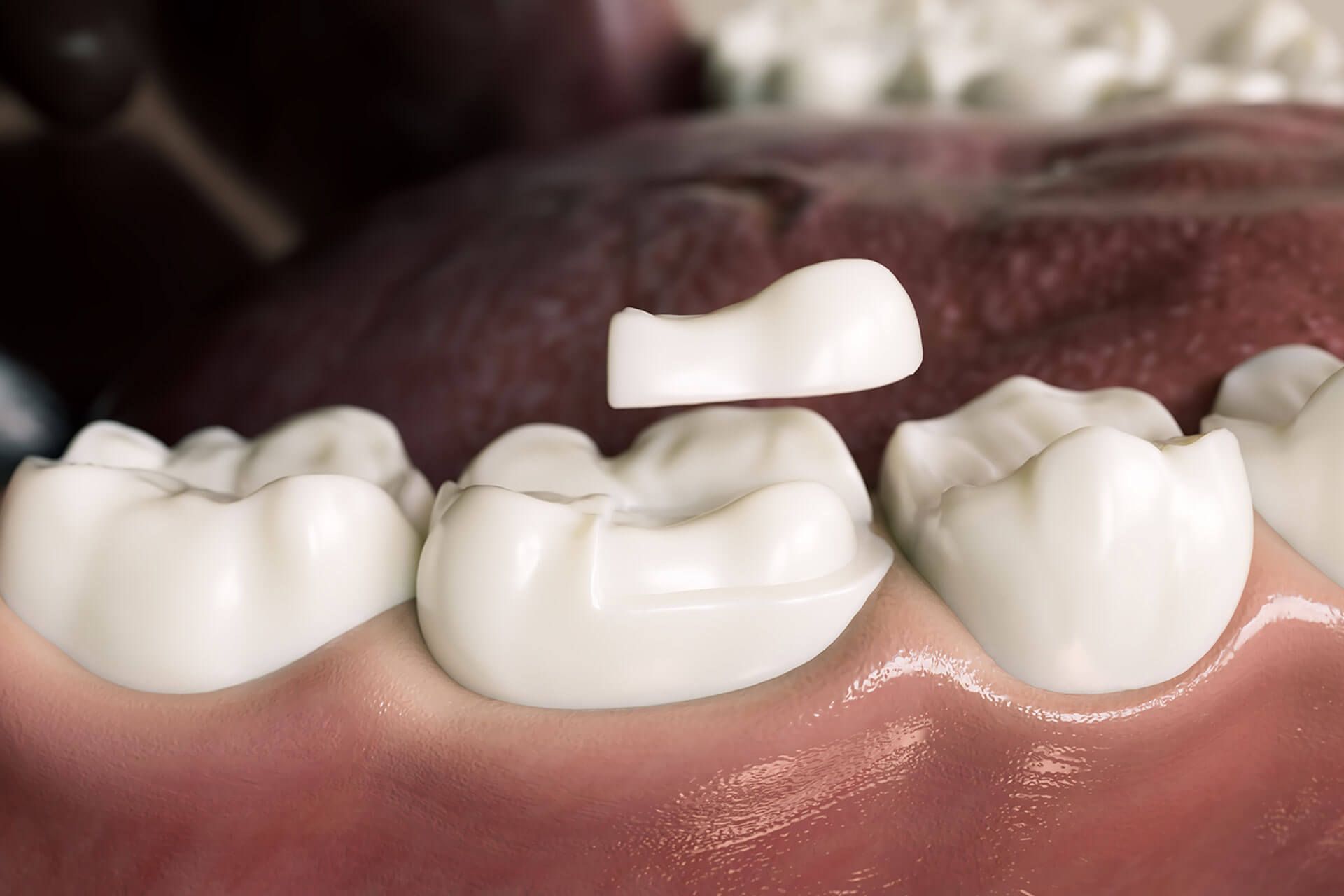 Ceramic Onlay quarter crown over a tooth- 3D Rendering