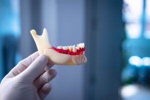 Tooth decay dentists dental model of teeth