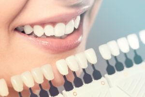 Matching the shades of the implants or the process of teeth whitening