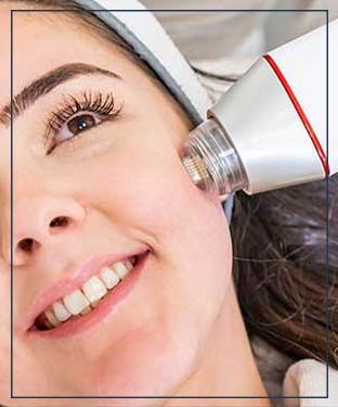 RF Microneedling