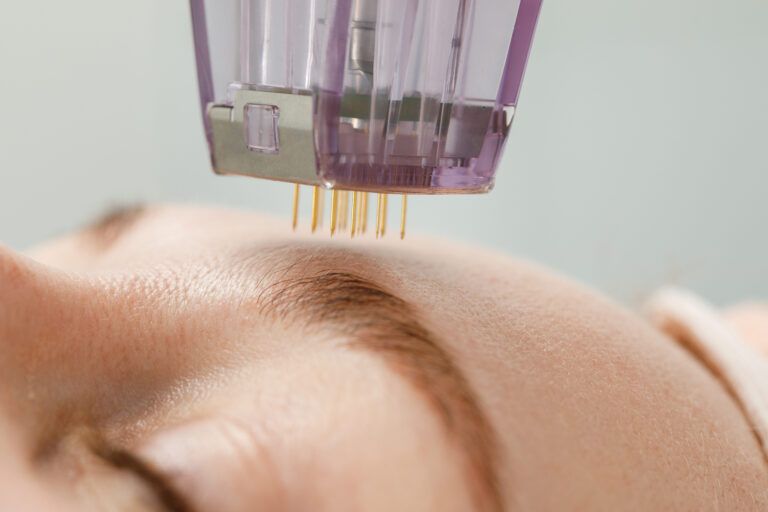 Microneedle mesotherapy