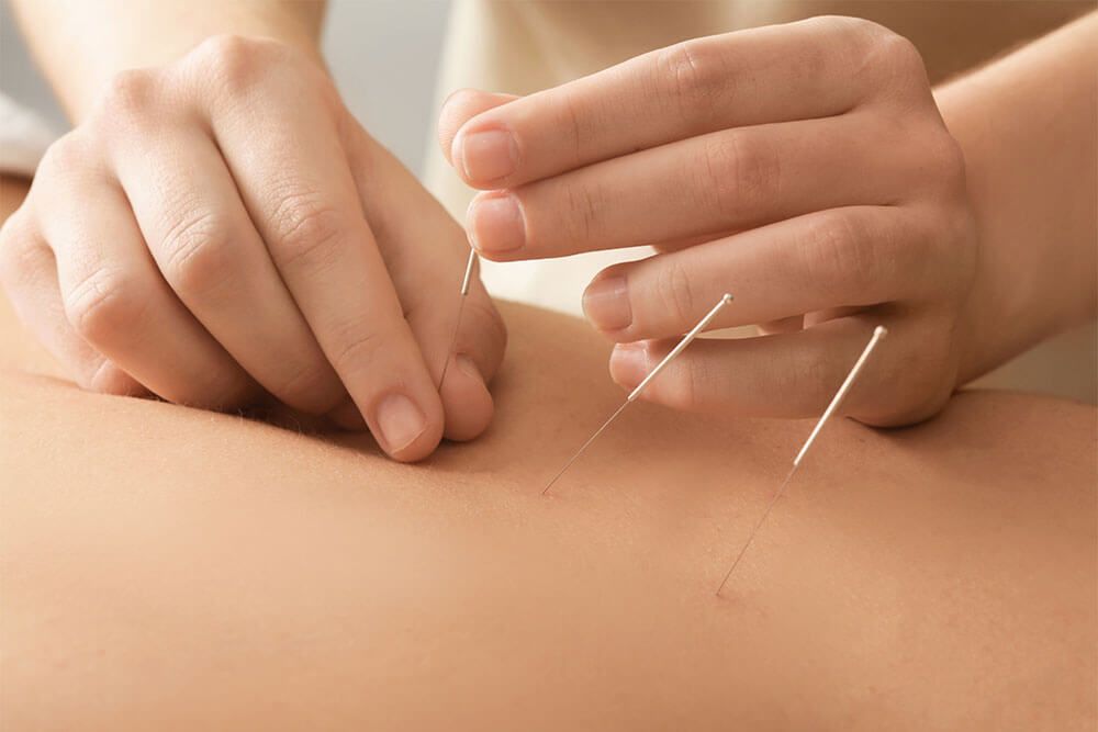 Needles therapy