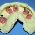 Shows model analogs in place in soft tissue