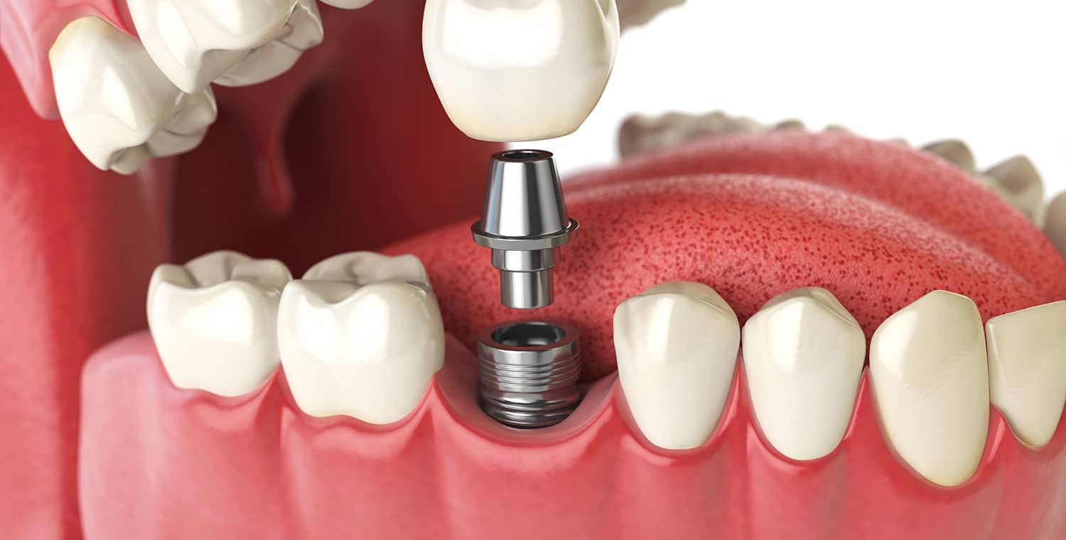 Dentures. 3d illustration