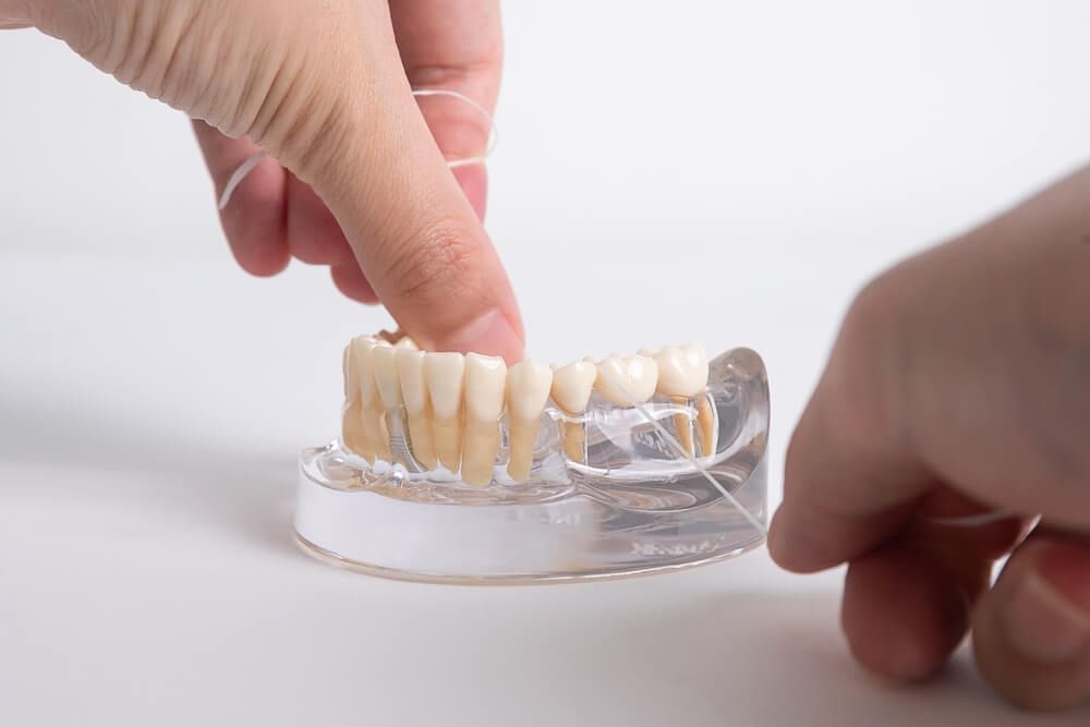 dental bridge