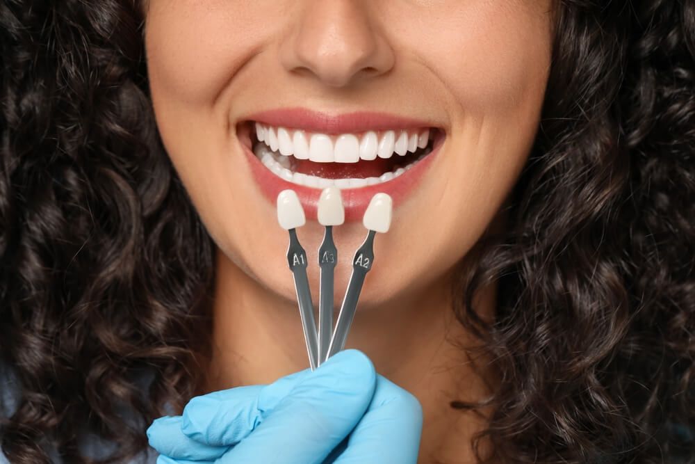 Veneers