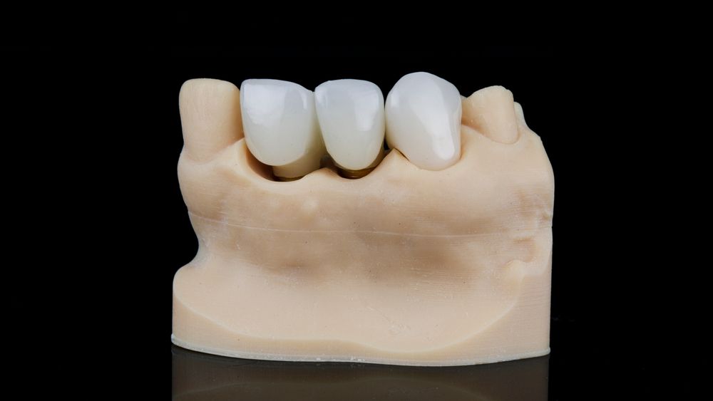 dental crown of high quality and accuracy on the dental model, shot on a black background
