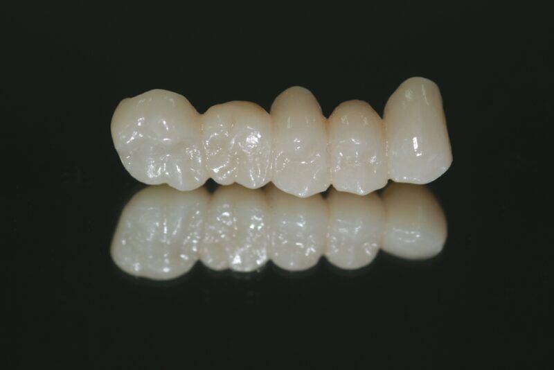 Full zirconia with long bridge after glazing and fix to the patient