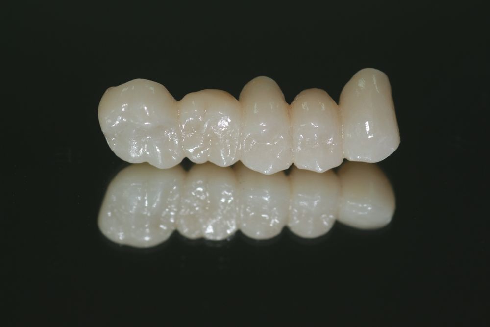 Full zirconia with long bridge after glazing and fix to the patient