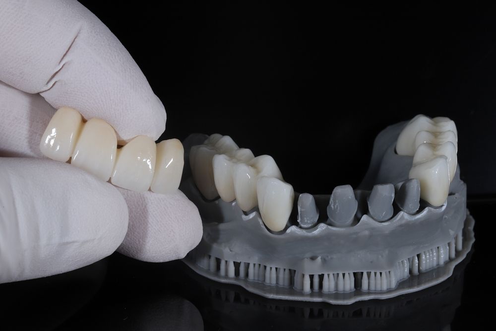 E-max or zirconia glass ceramic porcelain bridge crown treatment and implant-supported crown treatment