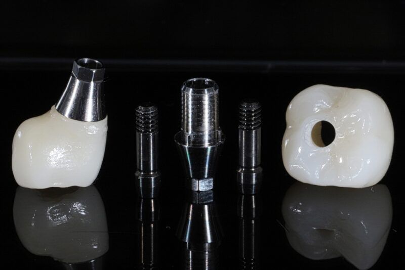 Porcelain single tooth treatment supported by a dental implant.