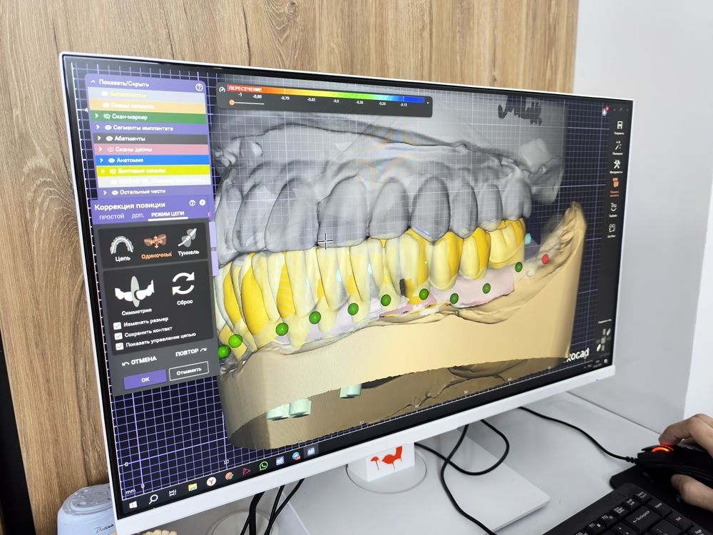 Dental design software displaying 3d teeth model on monitor screen.
