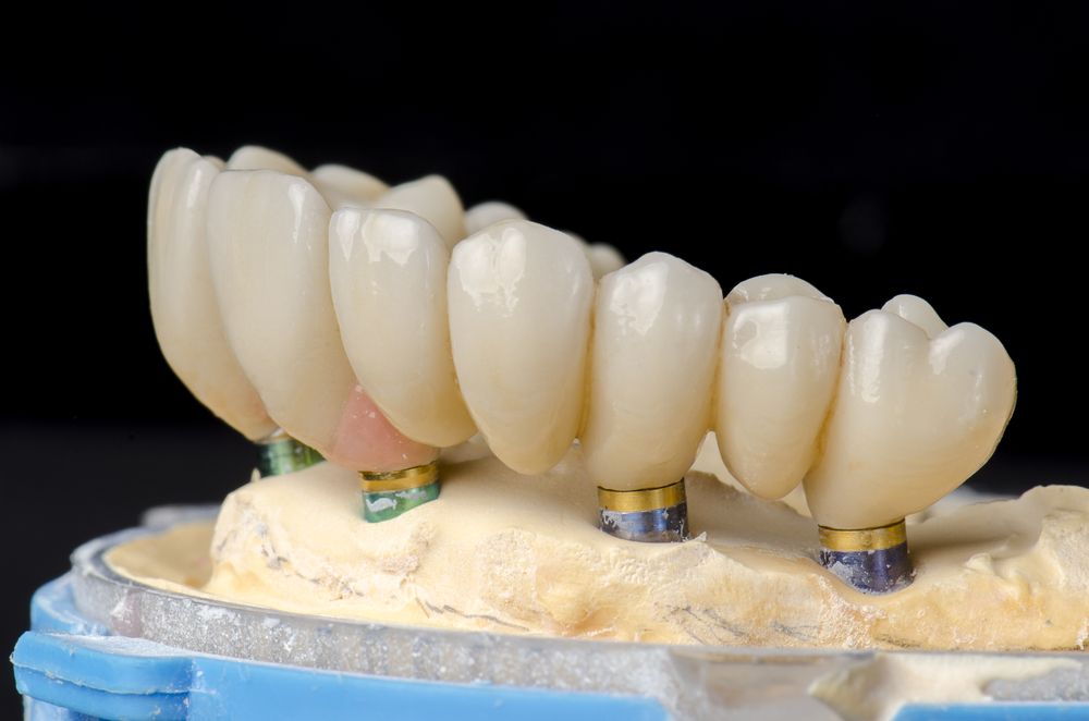 Monolithic zirconia restorations full arch implant supported with the ceramic load in vestibular, back background.