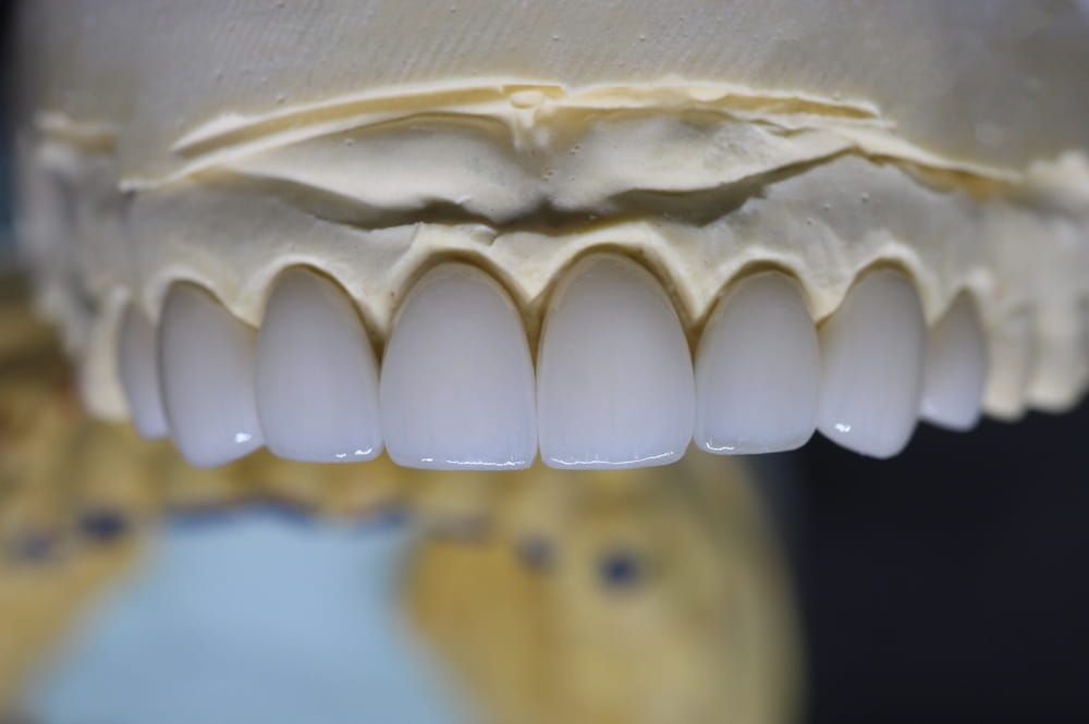 Dental Zirconia Crown and Bridge with Layering