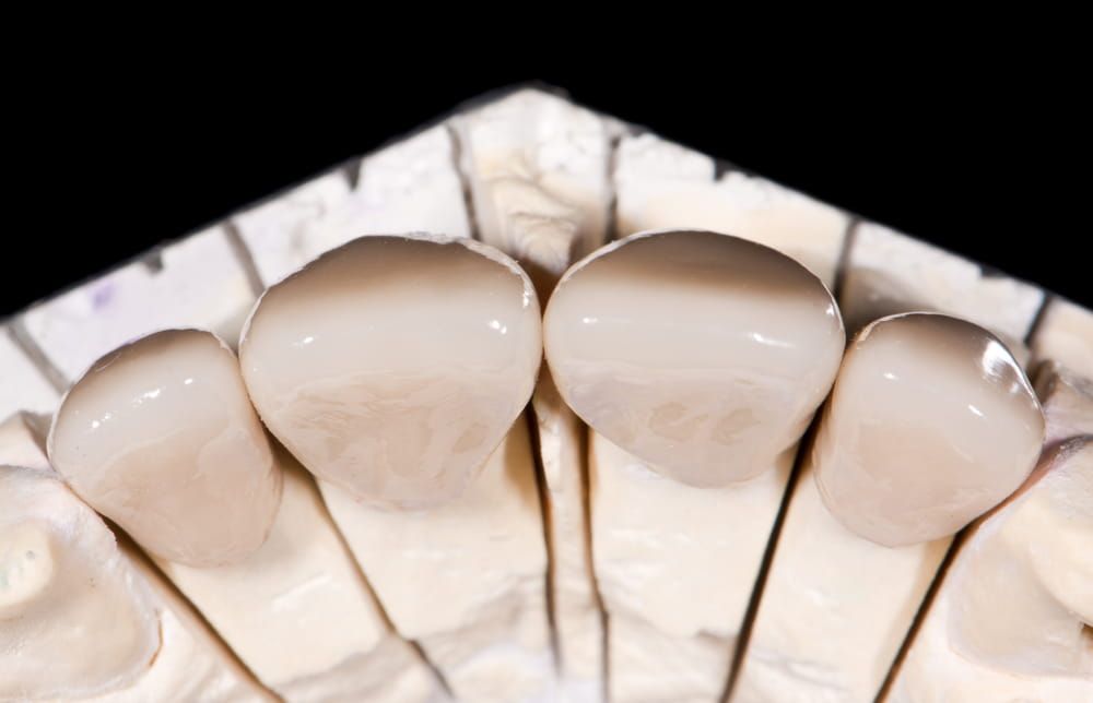 Frontal ceramic crowns in dental laboratory