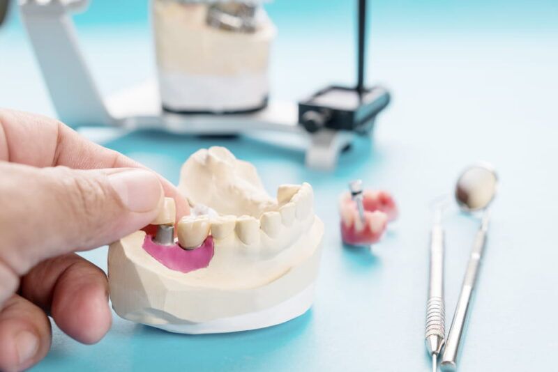 Implant Prosthodontics or Prosthetic / Tooth crown and bridge implant dentistry equipment and model express fix restoration.