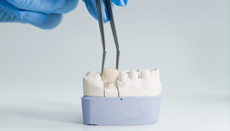 Close-up of a dental technician using tweezers to place a crown on a plaster model of teeth for prosthodontic fitting.