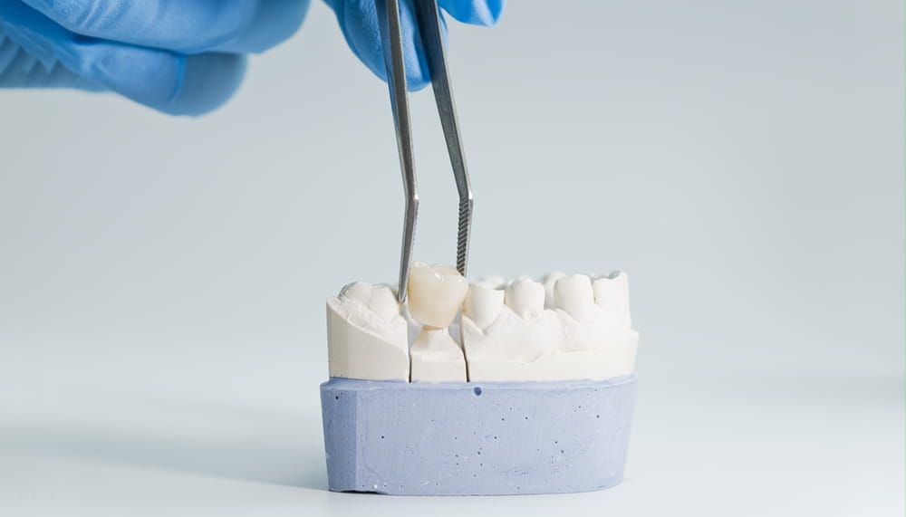 Close-up of a dental technician using tweezers to place a crown on a plaster model of teeth for prosthodontic fitting.