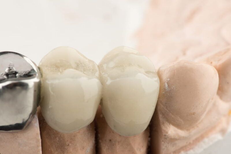 Bridged dental prostheses are made of steel and ceramic paste