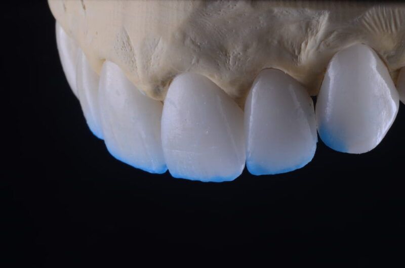 Dental Ceramic Laminate, injected work with emax press tab and incisal layering