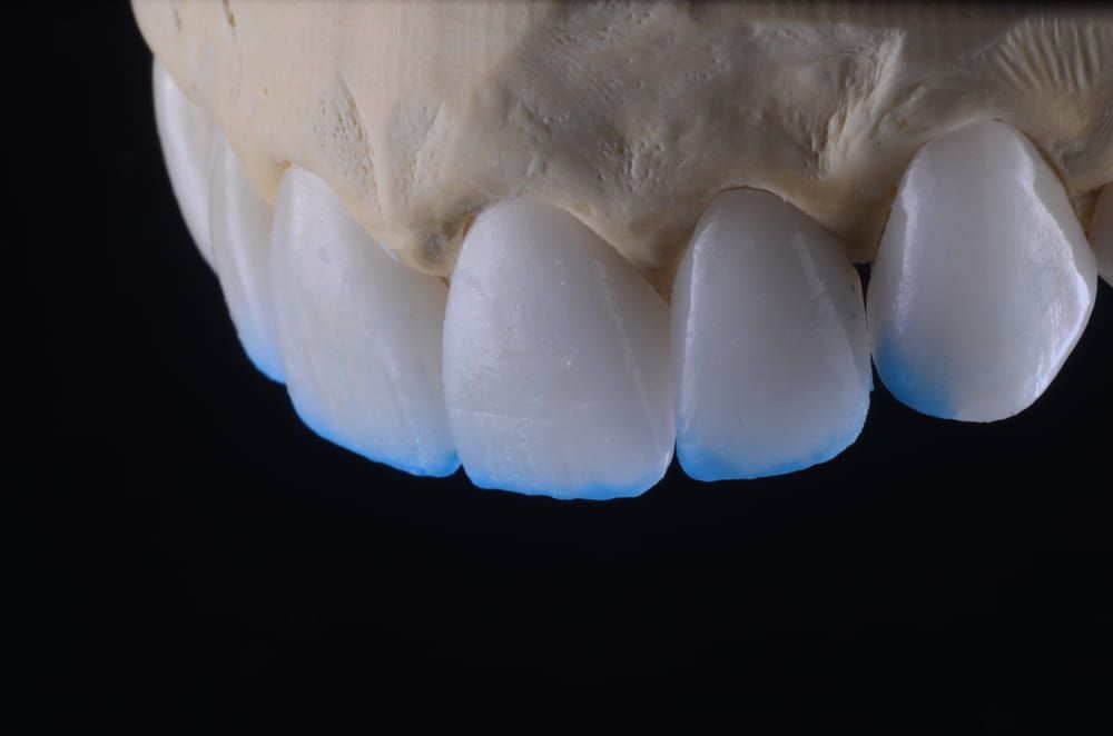 Dental Ceramic Laminate, injected work with emax press tab and incisal layering