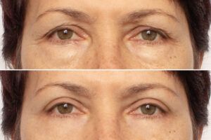 an elderly woman's eyes before and after blepharoplasty