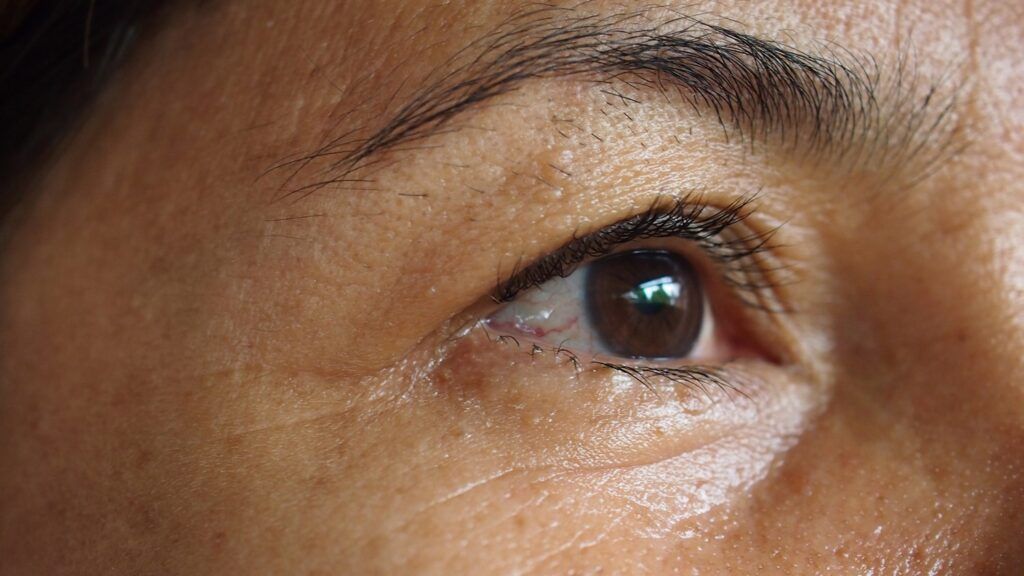 Patient's eye before treatment